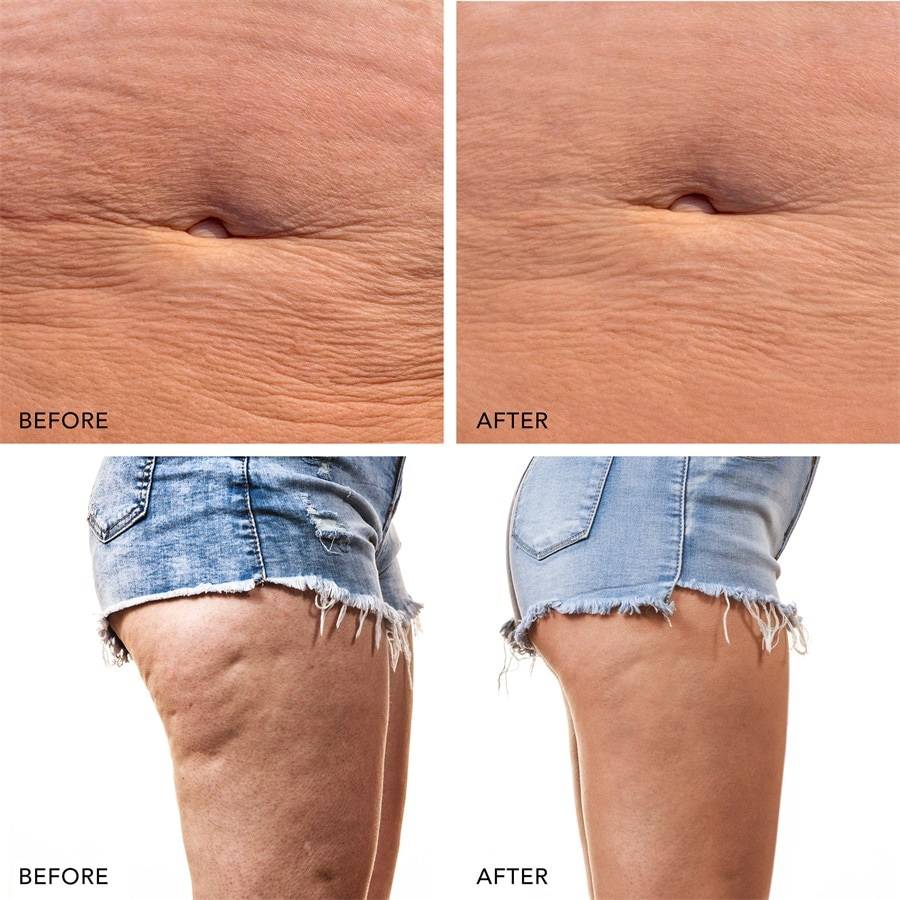 Foreo Body Vierteljährliche Förderung